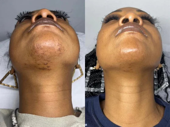 <h2><strong>Visibly Reduced Hair Growth In 30 Days</strong></h2>